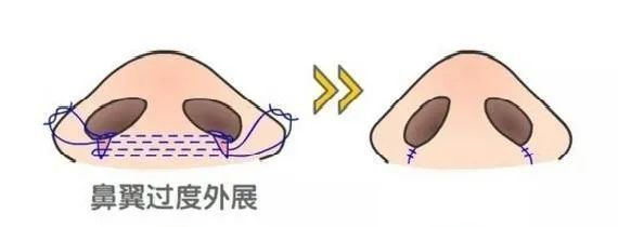 鼻头缩小鼻翼缩小前后对比图,鼻头缩小跟缩小鼻翼有区别吗