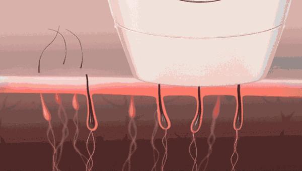 plmm脱毛产品,plmm测评