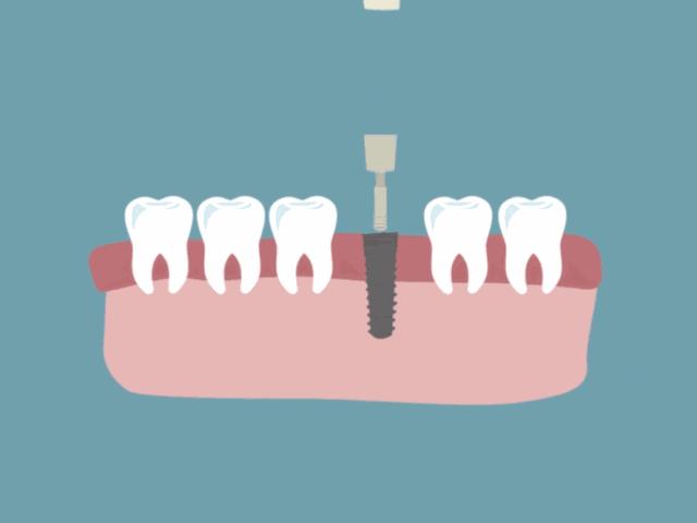 上午种牙下午就能用,上午种植牙下午就可以吃饭