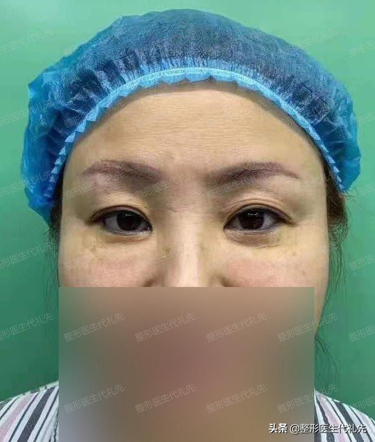 做全切双眼皮去眼袋恢复过程,45岁全切双眼皮亲身经历