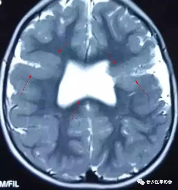 什么引起成人脑室扩大,哪些病可以导致左侧脑室增宽