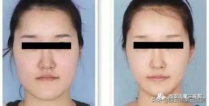 肉毒素能美白皮肤吗,肉毒素在医学美容的作用