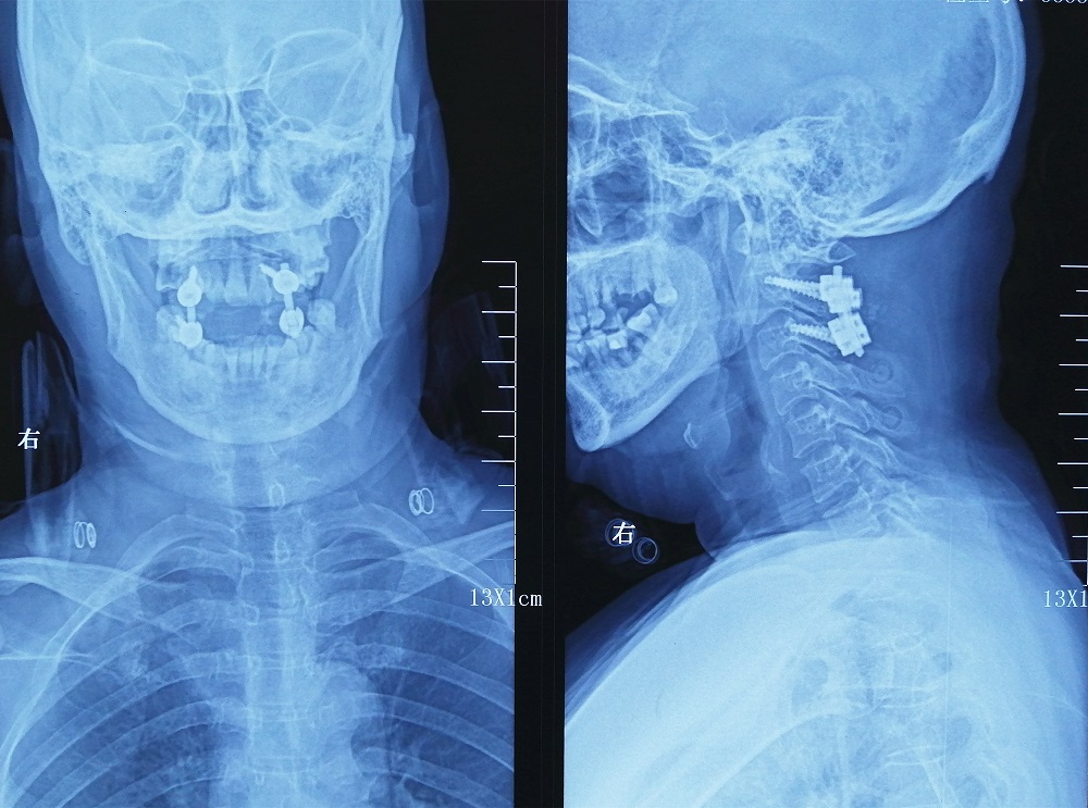 无缘无故手麻木伸不直,无缘无故两手发麻是什么情况