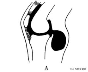 膝盖后面有个鼓鼓的包是不是病,膝盖后面有个包怎么回事