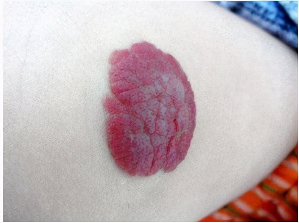 宝宝为什么出生后身上有很多青块,宝宝出生为什么有青胎记