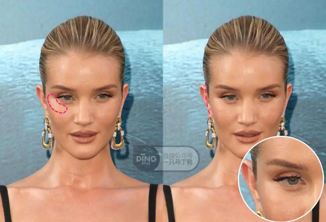 颧弓高脸型怎么改善,有泪沟可以通过调整脸型改善嘛