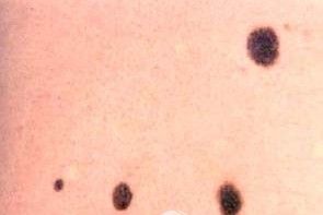 什么样的色素痣必须手术切除,色素痣怎么治疗呢