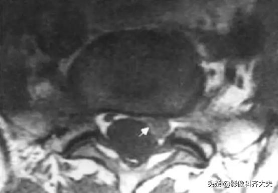 腰椎间盘突出是什么,腰椎间盘突出和腰间盘突出有区别吗