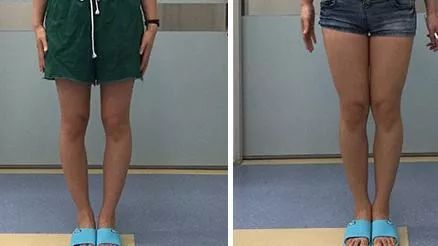 女的走路腿合不拢,为什么怀孕后腿合不拢了