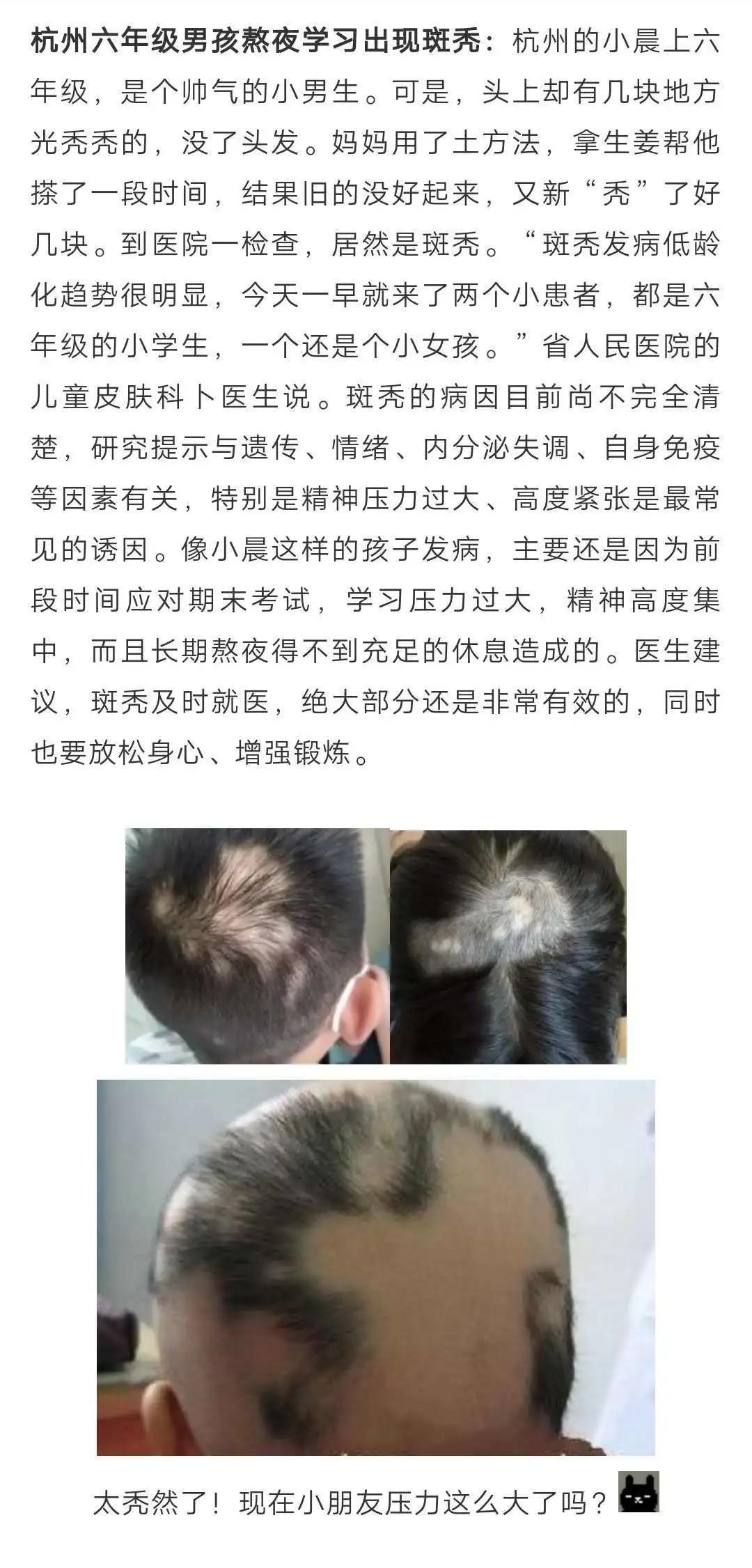 学习压力大导致脱发怎么办,压力导致的脱发还能恢复么