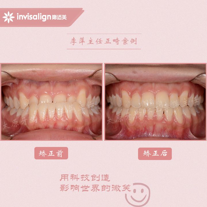 太原矫正牙齿需要做正颌吗,太原牙齿二次矫正