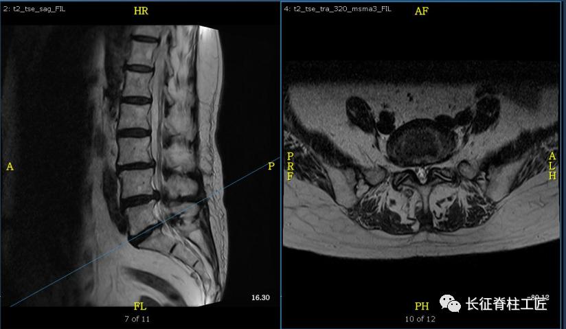 老年人腰椎管狭窄可以微创手术吗,老年人腰椎管狭窄瘫痪