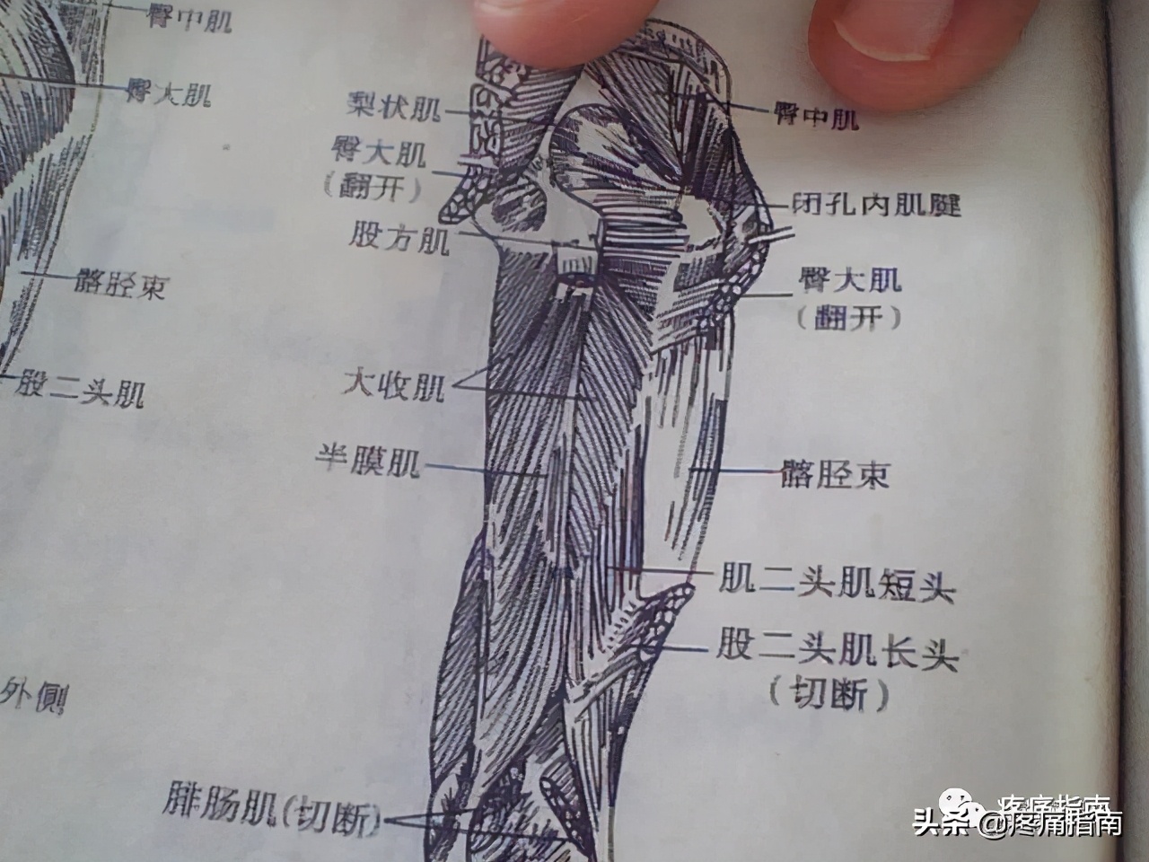 针刀治疗慢性膝关节炎详解图片,针刀治疗膝关节炎教学视频