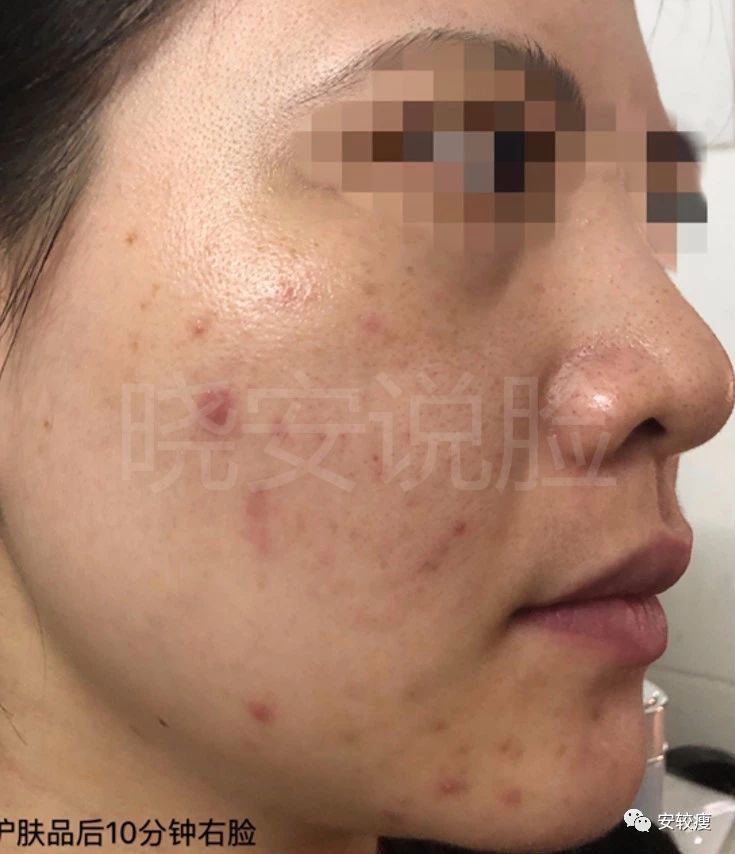 外油内干敏感痘肌怎么护肤,30岁油皮痘痘敏感肌怎么改善