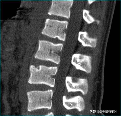 腰间盘突出脚麻腰疼怎么解决,腰间盘突出腰疼的不能动怎么办