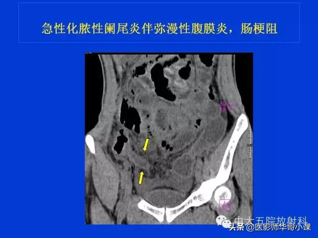 阑尾炎课件,阑尾炎的超声课件