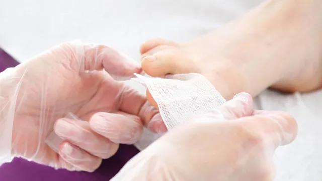 治疗灰指甲到底要花多少钱,激光治疗灰指甲多少钱