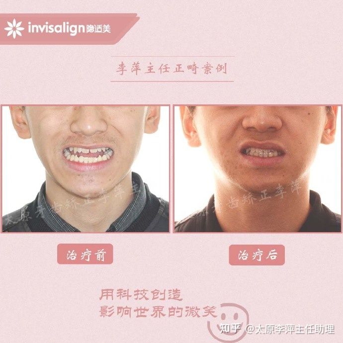 太原矫正牙齿需要做正颌吗,太原牙齿二次矫正