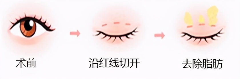 上眼皮松弛吃什么药,护肤上眼皮松弛直播