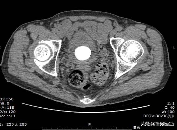 老人小便困难前列腺增生,前列腺增生和结石最好的治疗方法