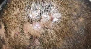 寻常性毛囊炎图片,穿掘性毛囊炎真实照片