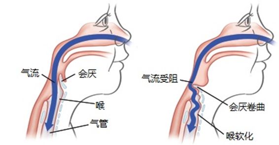 二岁儿童喉喘鸣缺钙怎么补钙,先天性喉喘鸣需要补钙吗
