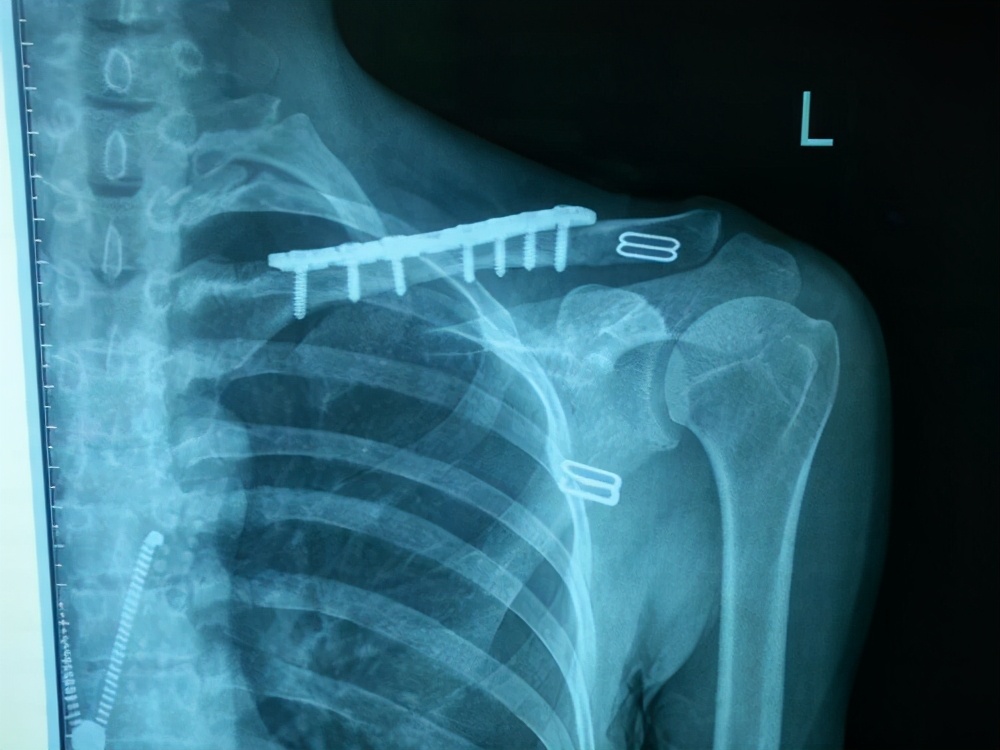 骨折上的钉还用取出来吗,骨折放的钢板是铁的吗