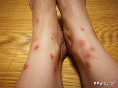 跳蚤可怕的克星,跳蚤可怕还是虱子可怕