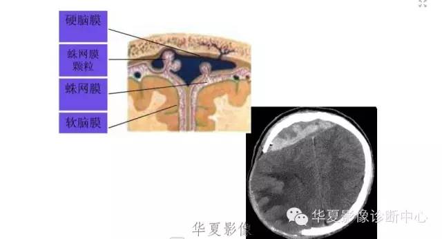 一文读懂颅内胆脂瘤,一文看懂背后的真相