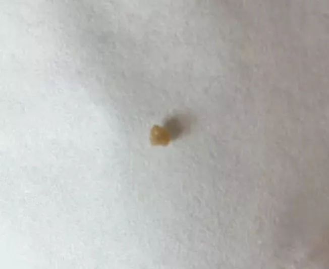 闭着嘴巴一直有口水,闭着嘴巴往外呼气的时候有臭味