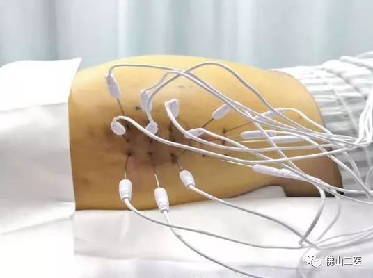 官宣丨阿伯腰腿疼痛多年，康复科首行“内热针”治疗帮其缓解