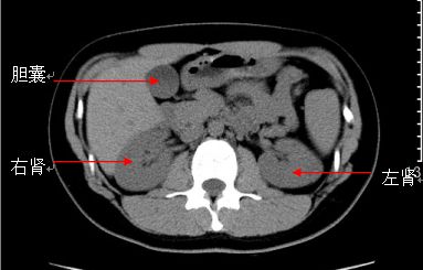 急诊科常见急腹症观察,腹部急诊影像大全值得收藏
