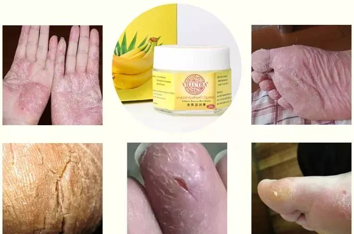 手脚冻疮怎么治断根,冬季治手脚干裂冻疮有效的药