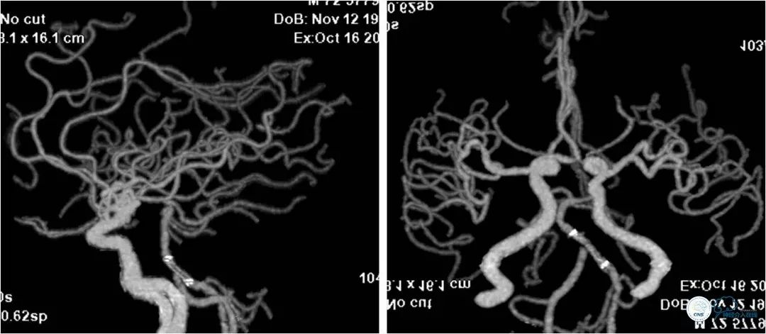 椎动脉狭窄介入手术病例汇报,基底动脉狭窄70%的介入治疗