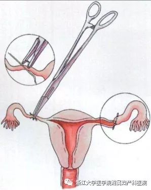 最推荐的避孕法,史上最实用的避孕指南