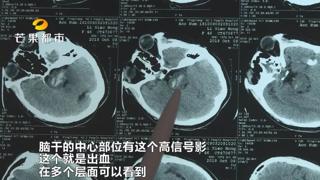 打麻将脑溢血,打麻将突发脑溢血抢救