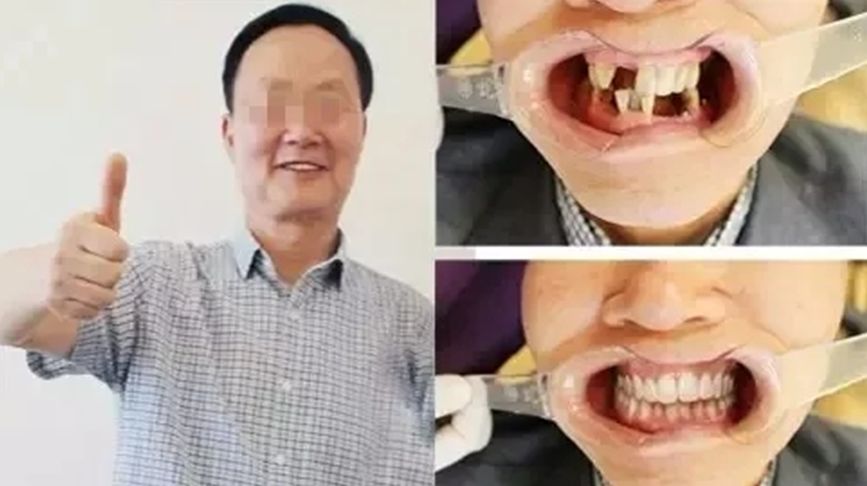 国家牙齿矫正种牙新政策,能全口种植牙齿一般需要多少钱