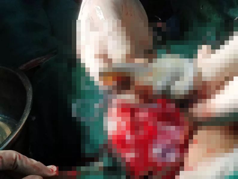 33岁女子产下一男婴,33岁女子怀上五胞胎