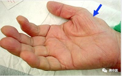 「警惕」手指麻痛，小心是腕管综合征！佛中医腕管镜微创治顽疾