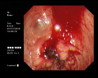 健康出现这些症状小心胃病来袭,健康科普胃溃疡反复发作会癌变吗