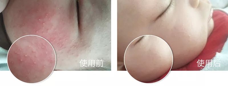 爸妈的手脚布满了老茧,手足干裂是什么前兆