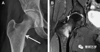 肩关节脱位易漏诊的骨折,放射科容易漏诊的骨折