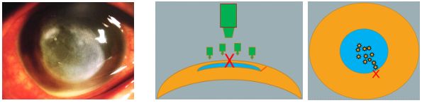 孙旭光眼科医生,孙旭光大夫角膜塑形镜危害
