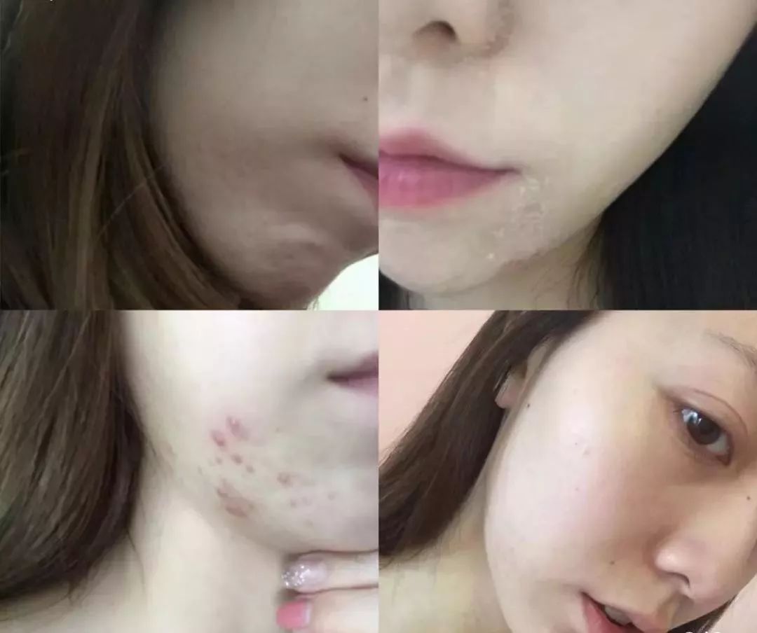 红肿,流脓的万年毒痘一喷全消失?岛国新晋痘肌终结者!彻底祛痘不反复!