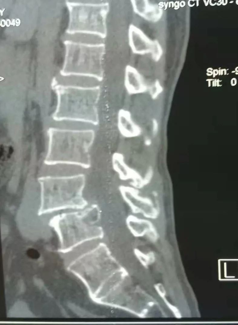 骨水泥治疗老年压缩性腰椎骨折,骨水泥治疗骨质疏松脊柱骨折