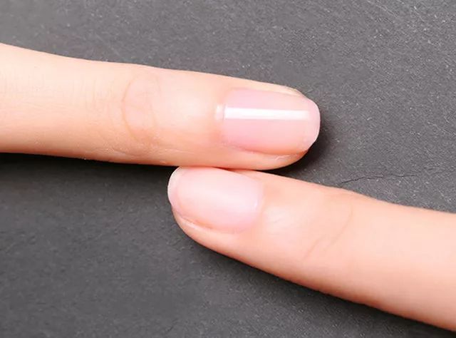 十年灰指甲可以治好吗,一次搞定顽固灰指甲