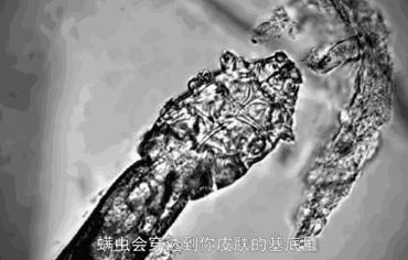 脸上螨虫黑头用完除螨皂好了,脸上有螨虫防螨皂