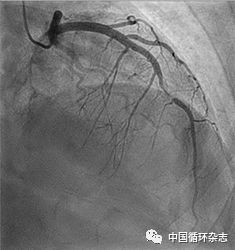 JAMA病例：年轻产妇胸痛，广泛ST段压低，心肌酶升高