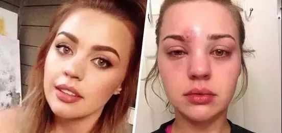 过了青春期长痘痘是什么原因,过了青春期还频繁长痘痘吗