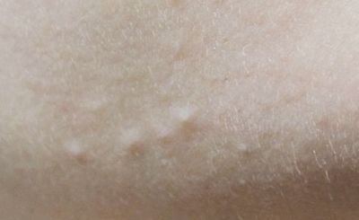 起粉刺了抹什么好,起了粉刺应该怎么护肤